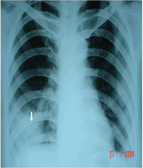 Xem hình ảnh về áp xe phổi để hiểu rõ hơn về tình trạng này và cách điều trị hiệu quả.