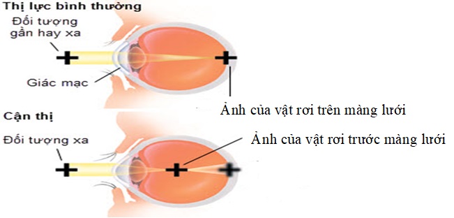 Điểm khác nhau giữa mắt bình thường và mắt bị cận thị