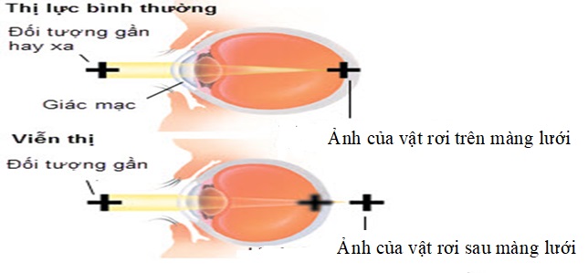 Sự khác nhau giữa mắt bình thường và mắt viễn thị