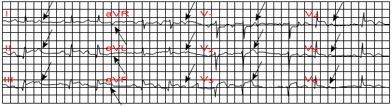 Nhồi máu cơ tim cấp làm tổn thương đường dẫn truyền nhĩ thất, gây block nhĩ thất độ hai Mobitz loại I (Wenckebach) trên hình ảnh điện tâm đồ