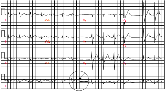Nhịp xoang với block nhĩ thất độ 2 Mobitz loại II, và block nhánh phải. Mũi tên chỉ ra sóng P không có QRS đi sau trên hình ảnh điện tâm đồ