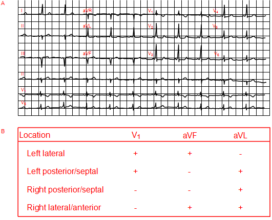 A, Wolff Parkinson White. B, Đường vị trí trong mô hình Wolff Parkinson White dựa trên phân cực của sóng delta trên hình ảnh điện tâm đồ