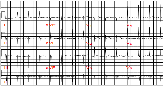 Trục điện tim lệch trái với tăng điện thế ở chuyển đạo aVL, nhưng không phì đại tâm thất trái. Chuyển dịch trục sang trái là do block nhánh trái trước  Trục điện tim lệch trái trên hình ảnh điện tâm đồ (LAD - left axis deviation): Trục QRS từ 00 đến âm 900.