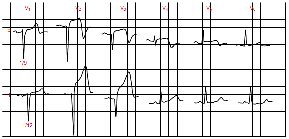 Khu vực viêm màng ngoài tim sau nhồi máu cơ tim cấp tính. b, nhồi máu cấp tính; f, độ cao liên tục ST V2-V4