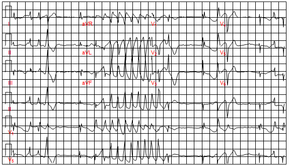 Block nhĩ thất hoàn toàn, block nhánh phải, QT kéo dài và nhịp tim nhanh thất đa hình thái ở bệnh nhân nhồi máu cơ tim cấp