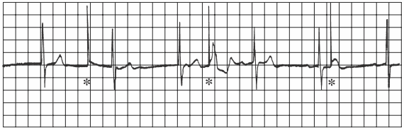 Máy tạo nhịp tim VVI không tạo nhịp (dấu sao thứ nhất), giữ cho nhịp bình thường (dấu hoa thị thứ hai), và không giữ nhịp (dấu hoa thị thứ ba) vì hiện tượng tạo nhịp xảy ra trong khi thất chống lại. Máy tạo nhịp không sinh ra phức bộ QRS (Máy tạo nhịp tim VVI hoạt động không tốt trên điện tâm đồ).