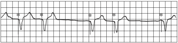 Cảm biến của máy tạo nhịp tim quá mạnh, dẫn đến nhịp tim chậm, không phù hợp, máy điều hòa nhịp tim không đều. Không thể biết những gì đã gửi tín hiệu quá mạnh trong dẫn mạch điện tâm đồ.