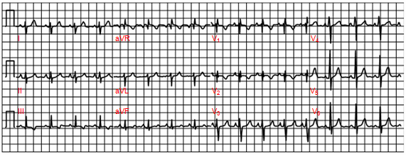 Trục điện tim lệch phải và RSR’ ở V1 dẫn với thời gian < 0,11 thứ phát trong một bé gái 6 tuổi bị khuyết tật thông liên nhĩ lỗ thứ hai