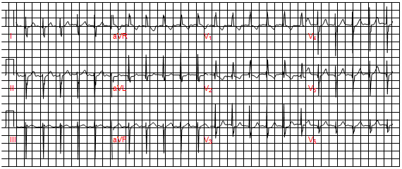 Trục điện tim lệch trái và RSR’ ở V1 dẫn với thời gian < 0,11 lần thứ hai trên bệnh nhân thông liên nhĩ lỗ thứ nhất