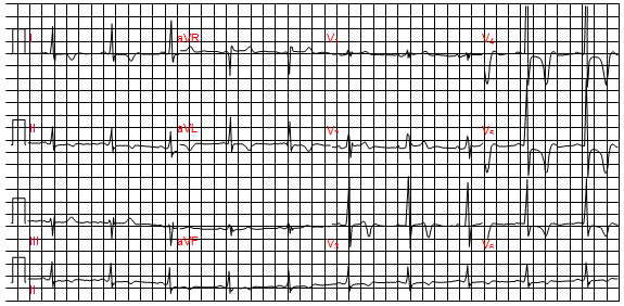 Điện tâm đồ bệnh cơ tim phì đại vùng đỉnh. Lưu ý sóng T sâu đối xứng làn sóng đảo ngược từ V3 qua V6