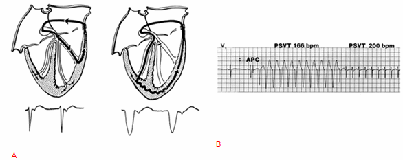 A, Nhịp tim nhanh vào lại nhĩ thất (AVRT) với đường phụ bên trái và dẫn truyền bình thường qua nhánh trái (bên trái); AVRT với cùng con đường phụ trái và block nhánh trái (trên bên phải) kết quả đường dẫn vòng quanh trong một phức hợp QRS kéo dài. B, Nhịp tim nhanh kịch phát trên thất (PSVT). Lưu ý rằng với sự hiện diện của block nhánh trái tại nơi bắt đầu của nhịp tim nhanh, tần số 166 nhịp mỗi phút (bpm). Block hóa giải, và dẫn thông qua đường con đường hồi phục bình thường, và nhịp tim nhanh có thể tăng tốc đến 200 nhịp mỗi phút với một phức hợp QRS hẹp. APC, co tâm nhĩ sớm.