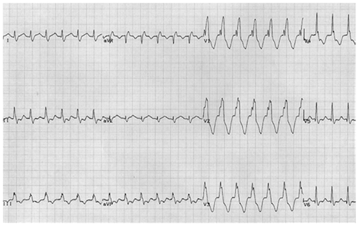 Nhịp tim nhanh phức bộ rộng do dị thường: Nhịp tim nhanh vào lại thuận chiều với block nhánh phải. Lưu ý mô hình block nhánh phải V1 rSR’ điển hình và phức bộ QRS tương đối hẹp