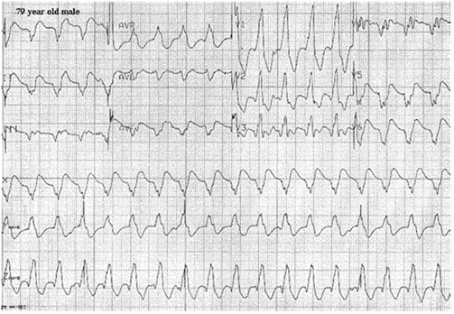 Nhịp tim nhanh phức bộ rộng do làm chậm nhịp tim nhanh thất. Lưu ý trục tây bắc, phức bộ QRS rộng, sóng R đơn lẻ trong V1, và sóng S nổi bật trong V6.