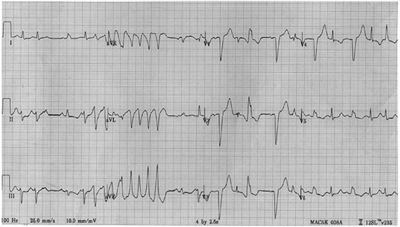 Nhịp tim nhanh thất tự phát đa hình từ hệ thống dẫn truyền mạng Purkinje thất trái  Không có hội chứng QT kéo dài. Lưu ý xen kẽ block nhánh phải và trái với các cơn co thắt tâm thất sớm (ngoại tâm thu thất)