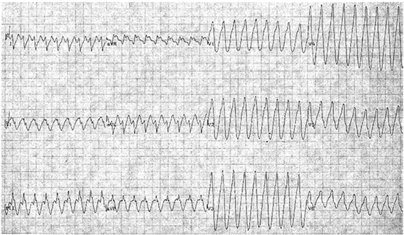 Nhịp tim nhanh vào lại ngược chiều bắt chước nhịp nhanh thất ở bệnh nhân với hội chứng Wolff Parkinson White. Lưu ý trục tây bắc và thời gian của phức bộ QRS