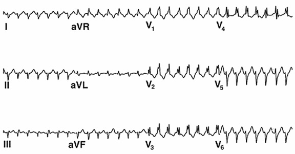 Verapamil nhạy cảm với nhịp nhanh thất (block nhánh phải với trục lệch trái) điển hình của nhịp nhanh thất có nguồn gốc từ khu vực bên bó trái sau của vách ngăn tâm thất trái. Lưu ý QRS tương đối hẹp