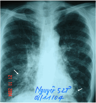 Hình ảnh giãn phế quản trên phim chụp phổi chuẩn ở bệnh nhân nam, 52 tuổi - Giãn phế quản