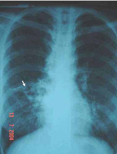 Hình ảnh giãn phế quản phổi phải trên phim phổi chuẩn ở bệnh nhân nam, 47 tuổi -  Tâm phế mạn do giãn phế quản
