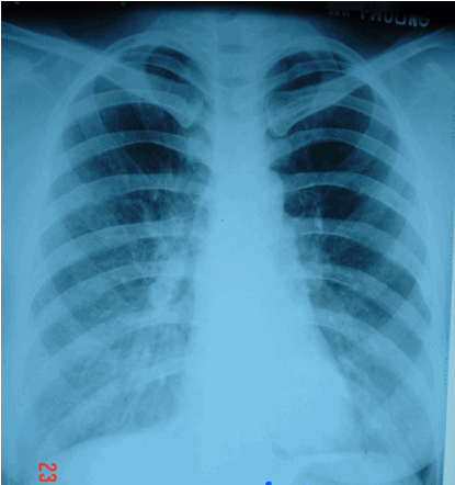 Viêm phổi điển hình. Hình ảnh mờ đáy phổi hai bên do viêm phổi ở bệnh nhân nữ 31 tuổi