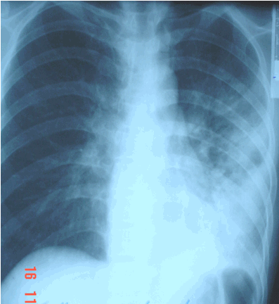 Hình ảnh viêm nửa dưới phổi trái và xẹp một phần phổi cùng bên do sặc dầu ở bệnh nhân nam, 31 tuổi 