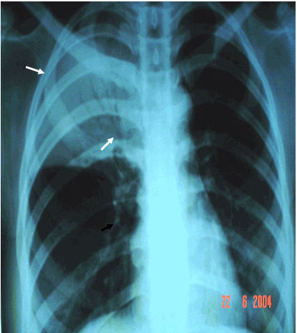 Hình ảnh viêm phổi thuỳ đỉnh phổi phải (hình ảnh các phế quản hơi - mũi tên dưới)
