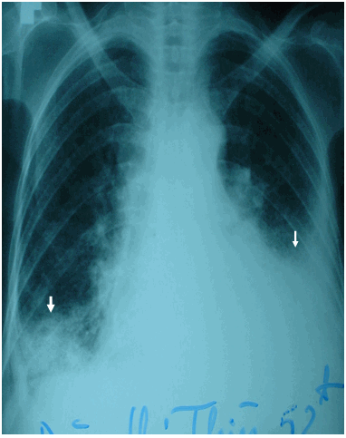 Hình ảnh viêm phổi có tràn dịch màng phổi hai bên trên phim phổi thường ở bệnh nhân nữ 52 tuổi - Viêm phổi gây tràn dịch màng phổi ở bệnh nhân Collagenose