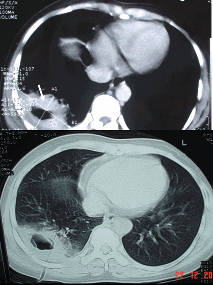  Hình ảnh ổ áp xe có mức nước mức hơi trên CT ngực ở cửa sổ trung thất & cửa sổ nhu mô của cùng bệnh nhân