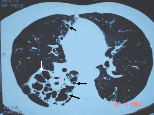 Hình ảnh giãn phế quản phổi phải dạng chùm nho trên phim trên phim chụp CT ở bệnh nhân nam, 47 tuổi - Tâm phế mạn do Giãn phế quản
