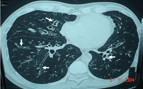 Hình ảnh giãn phế quản hình trụ (hai mũi tên dưới phải) giãn phế quản hình chùm nho (mũi tên trên phải & dưới trái) ở bệnh nhân nam, 52 tuổi - Giãn phế quản