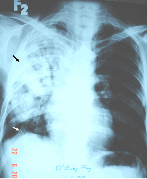 Hình ảnh lao gần toàn bộ phổi phải kèm theo khí quản bị kéo lệch sang bên bệnh, vòm hoành bị kéo lên cao do tổn thương lao co kéo & gây xẹp phổi 