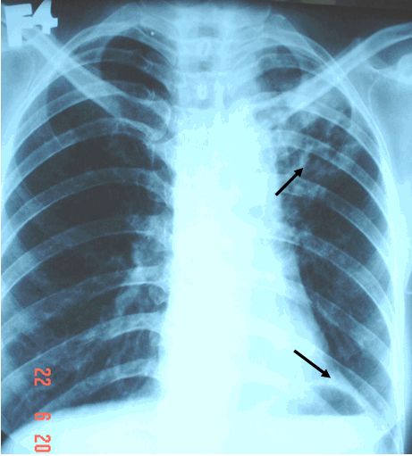 Hình ảnh lao thuỳ trên phổi trái & vòm hoành trái bị kéo lên cao do tổn thương lao co kéo