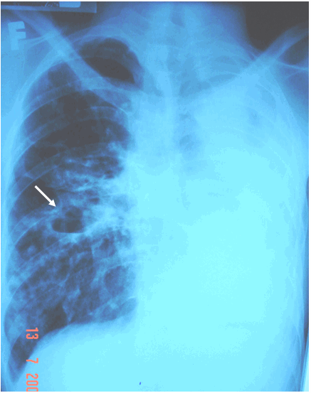 Hình ảnh  lao hang phổi phải có mức nước mức hơi & xẹp toàn bộ phổi trái (khí quản & các cơ quan trung thất bị kéo lệch về bên trái)