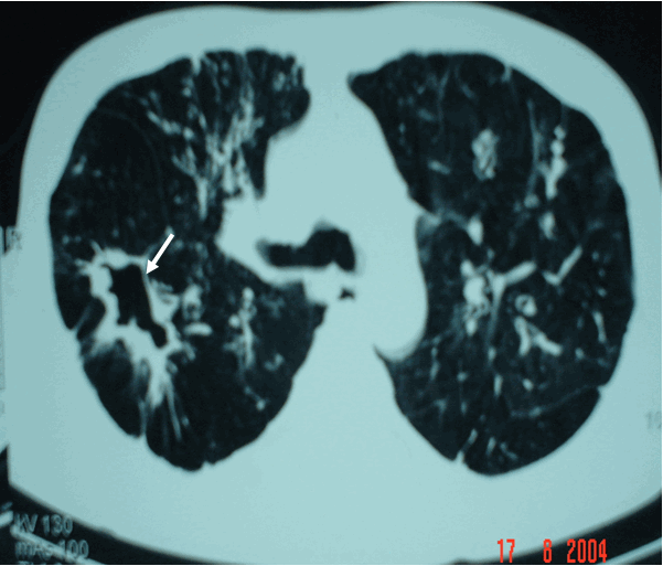 Hình ảnh lao hang phổi phải trên phim CT, thành hang dày, bờ nham nhở