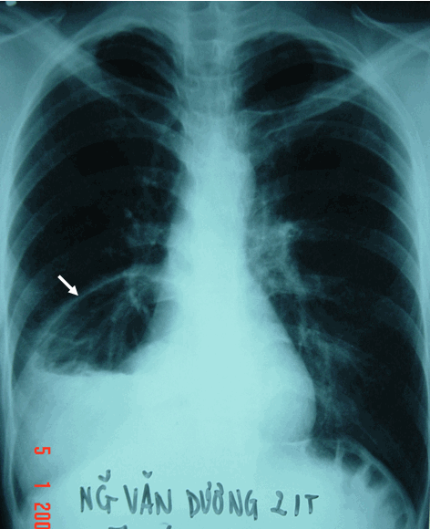 Hình ảnh thoát vị hoành (thoát vị dạ dày) có mức mức hơi giống áp xe phổi ở bệnh nhân nam, 21 tuổi