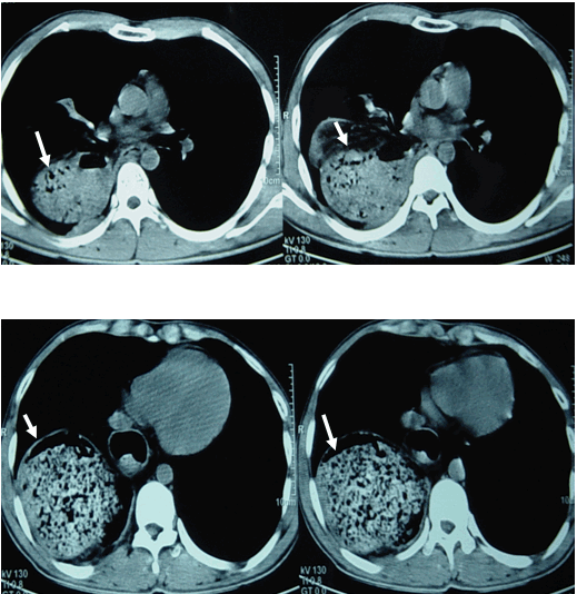 Hình ảnh khối thức ăn lổn nhổn ở vùng đáy phổi phải trên phim chụp cắt lớp phổi ở cửa sổ trung thất của cùng bệnh nhân nam, 21 tuổi - Thoát vị dạ dày