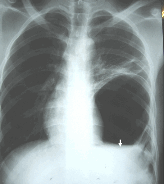 Hình ảnh thoát vị hoành trái trên phim chụp phổi thẳng có mức nước mức hơi giống hình ảnh của áp xe phổi trái