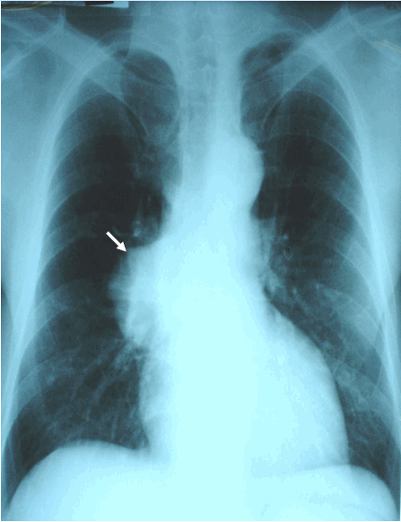 Hình ảnh K phổi phải thể ngoại vi ở phía sau trên chụp phổi thẳng ở bệnh nhân nam, 62 tuổi - Ung thư phổi phải