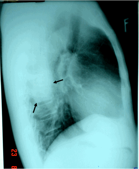  Hình ảnh K phổi thể ngoại vi ở phía sau sát cột sống trên phim phổi chụp nghiêng phải ở cùng bệnh nhân