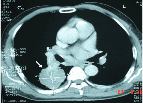 Hình ảnh k phổi thể ngoại vi ở phía sau trên phim chụp CT ngực cùng bệnh nhân
