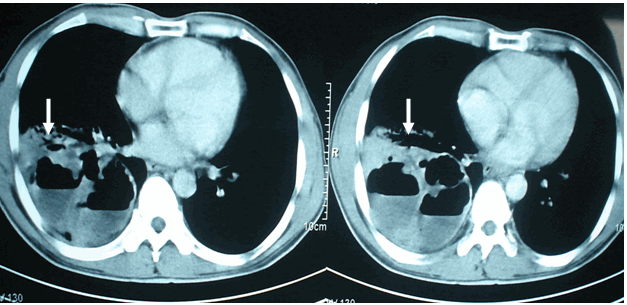 Hình ảnh u phổi áp xe hóa nhiều ổ có mức nước mức hơi được phát hiện trên phim chụp cắt lớp vi tính mà trên phim phổi thường không phát hiện được ở cùng bệnh nhân nam, 47 tuổi - Ung thu phổi áp xe hóa 