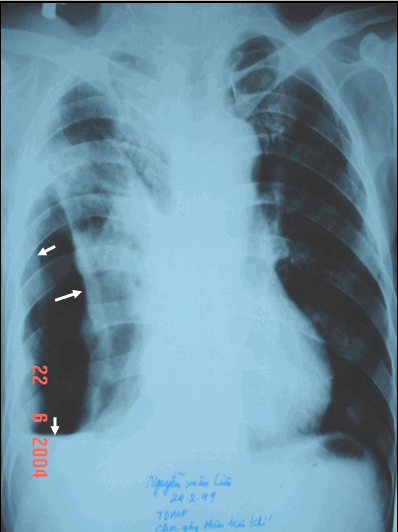 Hình ảnh màng phổi dày & dính trong TDMP phải do lao, kèm tràn dịch tràn khí màng phổi có mức nước nằm ngang