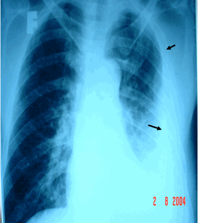 Hình ảnh dày dính & vôi hoá màng phổi trên phim phổi chuẩn ở bệnh nhân nam, 56 tuổi  Dày dính màng phổi trái do lao