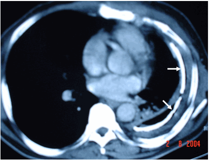 Hình ảnh màng phổi trái dày & vôi hoá trên phim chụp cắt lớp ngực ở bệnh nhân nam, 56 tuổi  Dày dính màng phổi trái do lao
