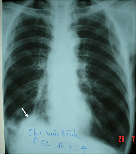 Hình ảnh đám mờ đáy phổi phải xâm lấn tổ chức xung quanh ở bệnh nhân nam, 62 tuổi Ung thư phổi phải
