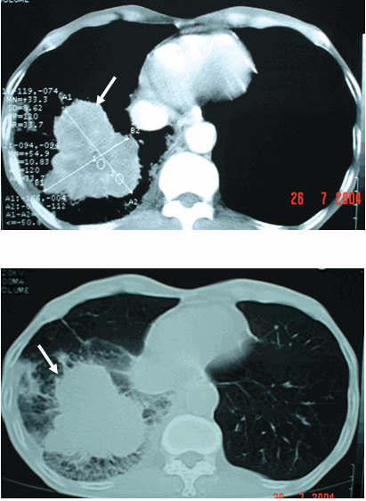 Hình ảnh khối u có vô số chân (vòi bạch tuộc) ở cửa sổ nhu mô bám vào tổ chức xung quanh ở bệnh nhân nam, 62 tuổi - Ung thư phổi phải   