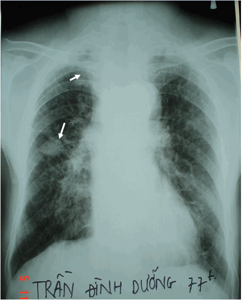 Hình ảnh khối u trong hội chứng chèn ép tĩnh mạch chủ trên (mũi tên trên) & hình ảnh tràn dịch màng phổi thể rãnh liên thuỳ nhỏ (mũi tên dưới) trên phim phổi chuẩn ở  bệnh nhân nam, 77 tuổi -  H/C chèn ép tĩnh mạch chủ trên