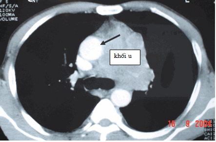Hình ảnh khối u chèn ép & đẩy quai động mạch chủ sang phải trên CT ngực ở bệnh nhân nam, 43 tuổi Hội chứng trung thất