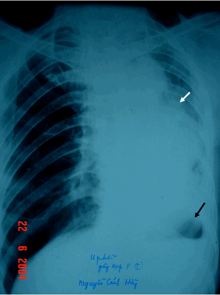 Hình ảnh khối u gây xẹp gần toàn bộ phổi trái vòm hoành trái bị kéo lên cao
