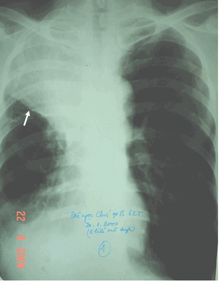 Hình ảnh xẹp thuỳ đỉnh phổi phải kéo hẳn tim sang bên tổn thương & vòm hoành cùng bên cũng bị kéo lên cao