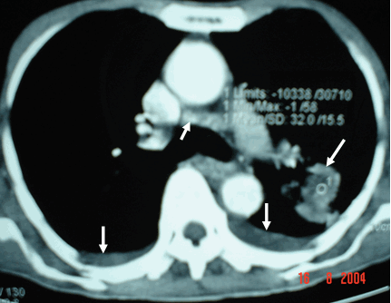 Hình ảnh khối u bên phổi trái ngấm thuốc mạnh có hạch trung thất to (mũi tên trên cùng) & tràn dịch màng phổi ở cả hai bên (hai mũi tên dưới)     